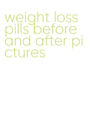 weight loss pills before and after pictures