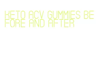 keto acv gummies before and after